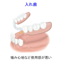 入れ歯